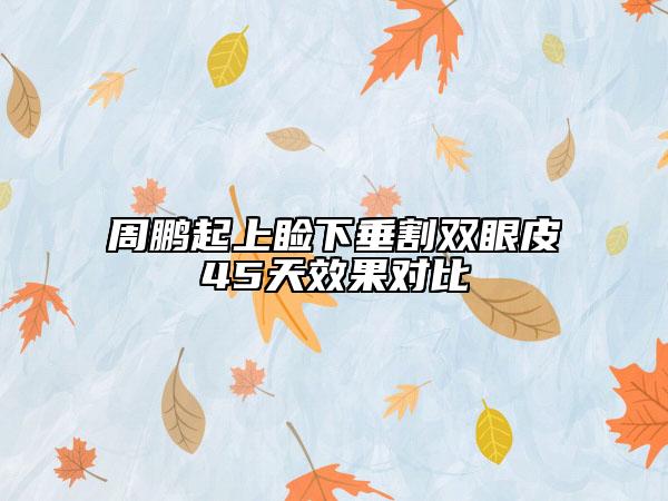 周鹏起上睑下垂割双眼皮45天效果对比